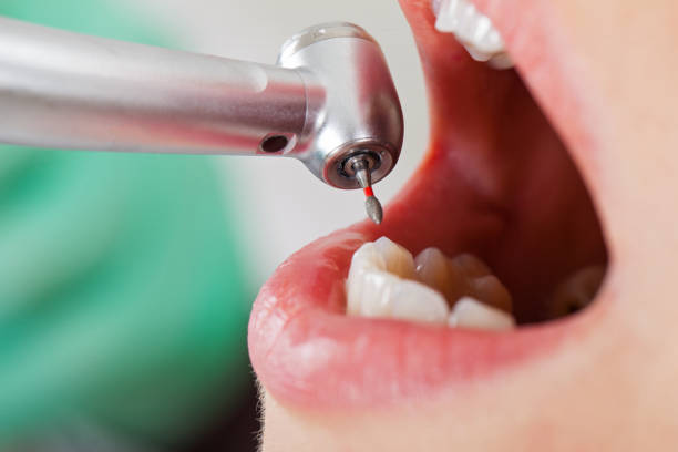 Best Emergency Root Canal Treatment in Pecan Plantation, TX